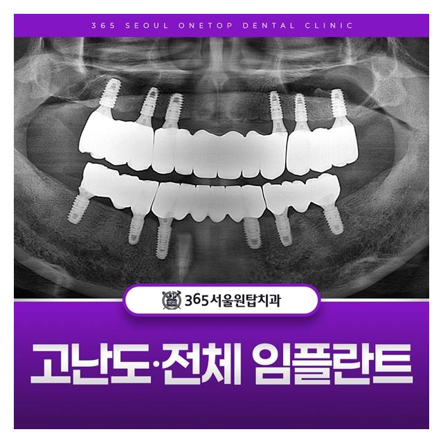 고난도,전체 임플란트 치료로 씹는 즐거움 되찾으세요.