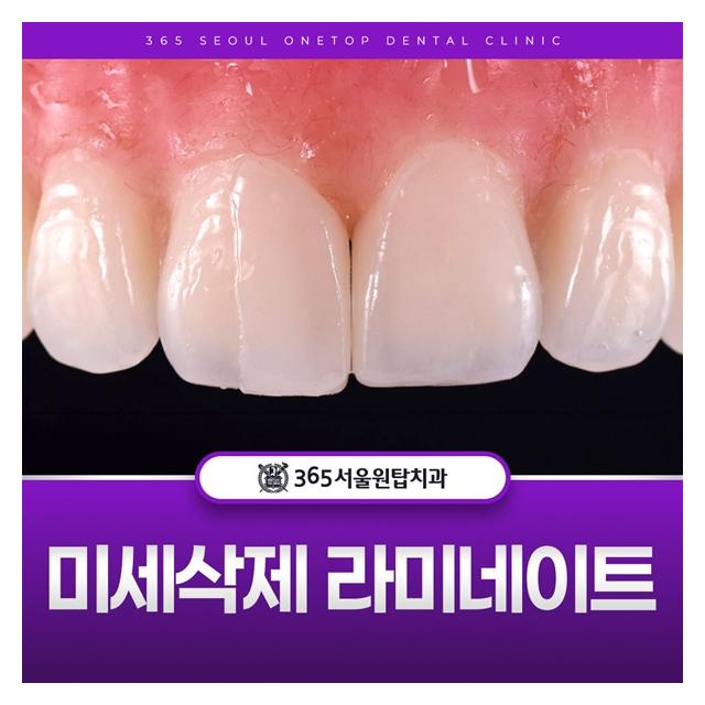 미세삭제 라미네이트, 티나지 않는 자연스러움